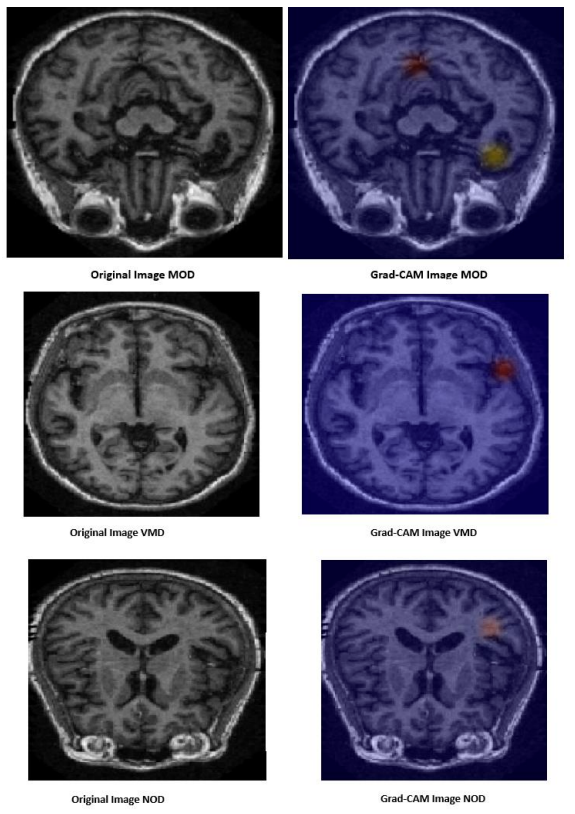 Deep Learning for Early Alzheimer Disease Detection with MRI Scans — 論文の図版